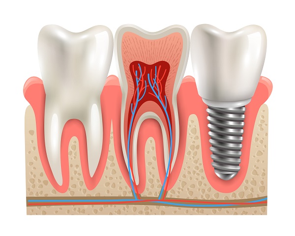 Key Things to Know About Bone Grafting Procedures