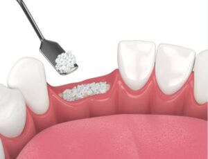 Key Things to Know About Bone Grafting Procedures