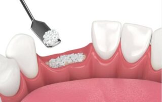 Key Things to Know About Bone Grafting Procedures