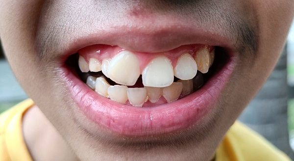 Crooked teeth of a young Asian boy