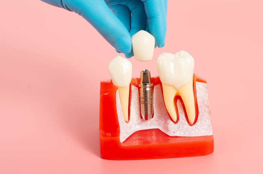 Dental Implants Medford