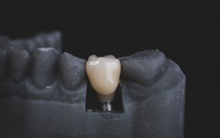 When Would You Need a Dental Crown