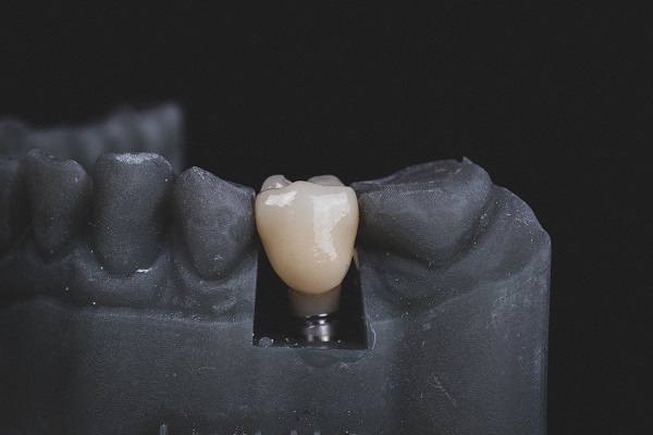 When Would You Need a Dental Crown