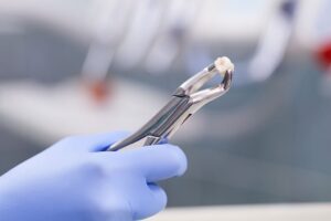 Tooth Extraction Medford