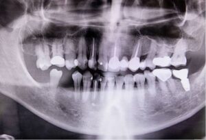 Dental Bone Grafting