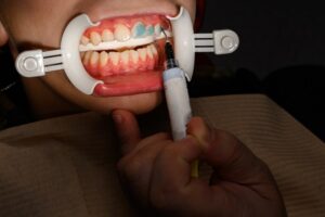 Dental Fillings Medford