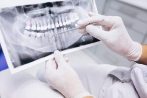 Root Canal Medford