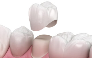 Preparated premolar tooth and dental crown placement. Medically accurate 3D illustration