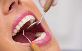 Dental Bonding in Medford