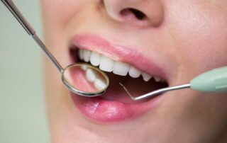 Dental Bonding