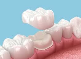 Dental Crowns in Medford