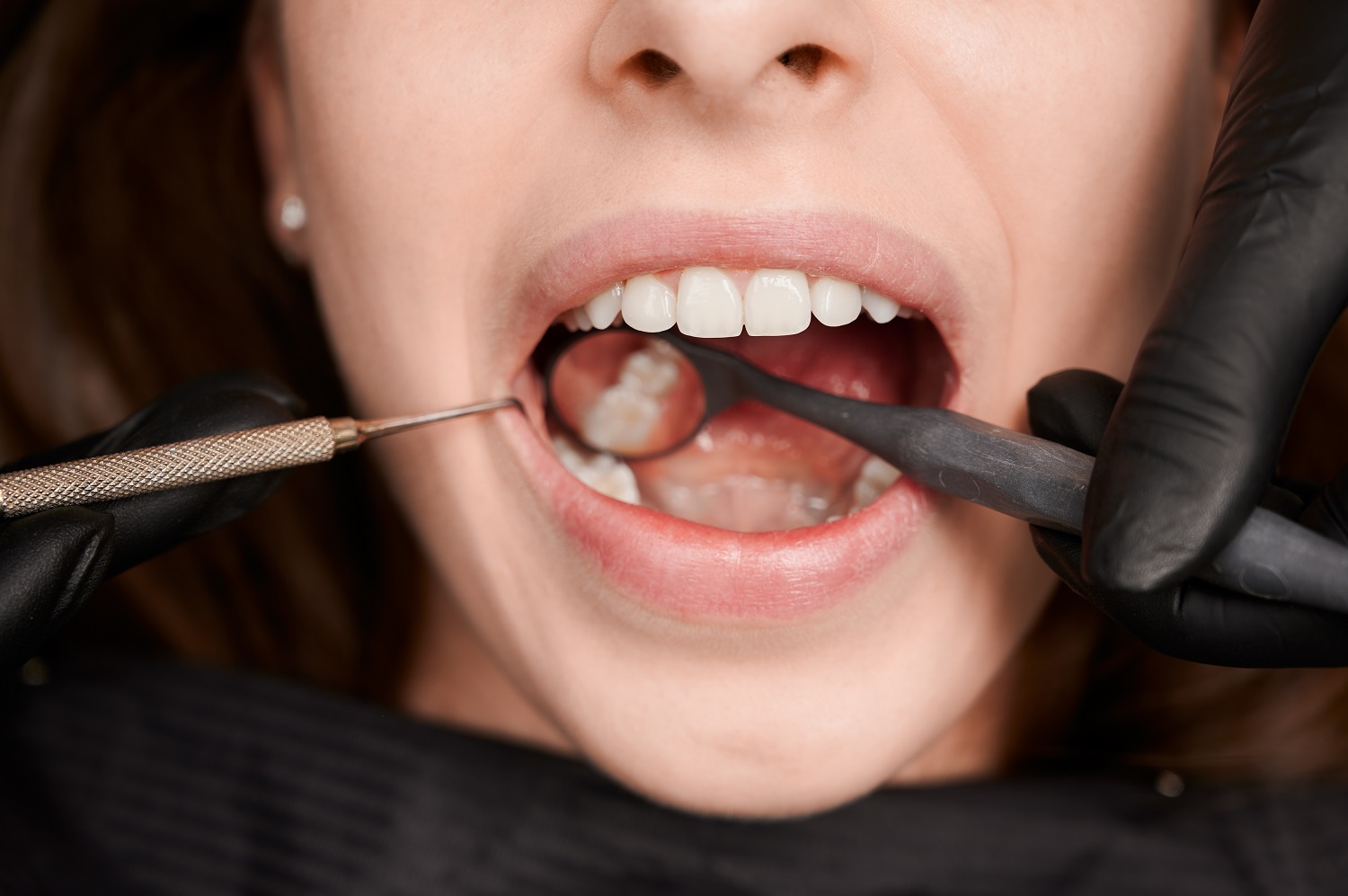 Medford Dental Fillings