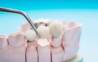 dental crowns in Medford
